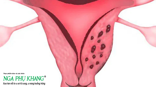 Lạc nội mạc tử cung là một trong những nguyên nhân bị u nang buồng trứng mà nữ giới hay gặp phải